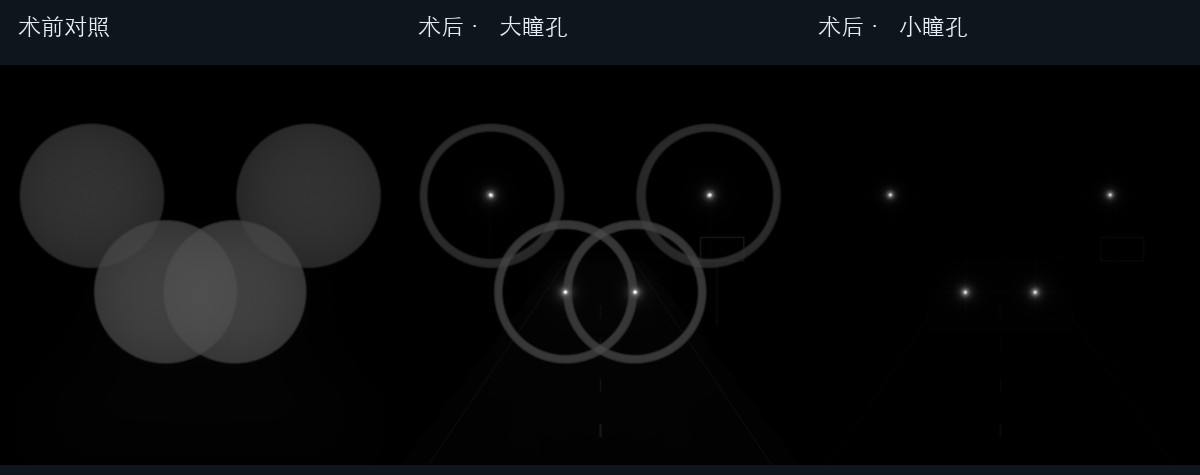 合成模型中未植入、术后大瞳孔与术后小瞳孔的统一显示对照